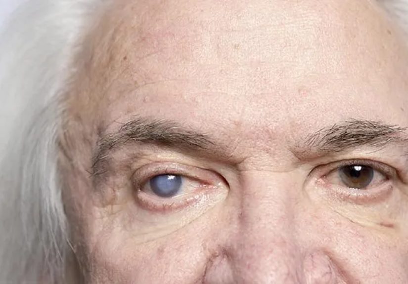 Cataract Symptoms: Blurry Vision, Double Vision, and More