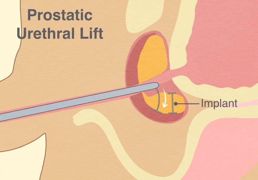 How to Reduce Prostate Size: Lifestyle Changes & More