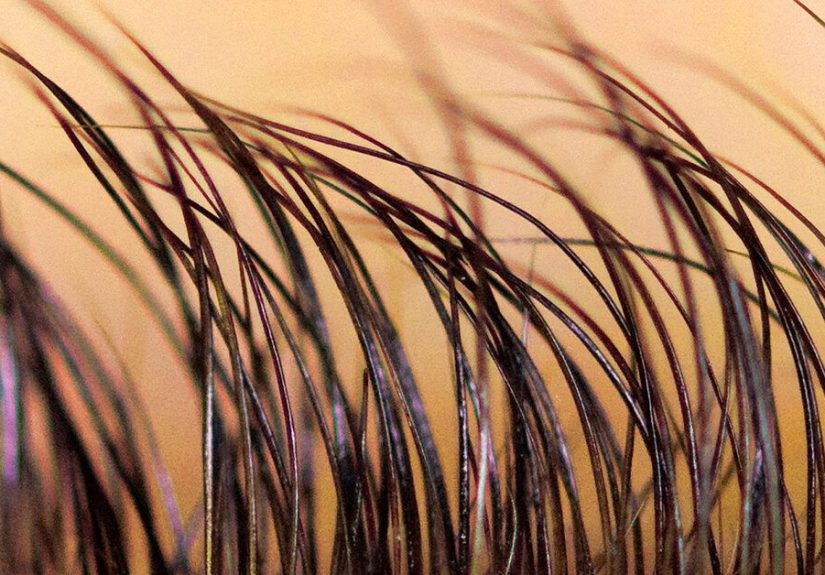 Trichotillomania: Symptoms, Causes, Treatment, and More