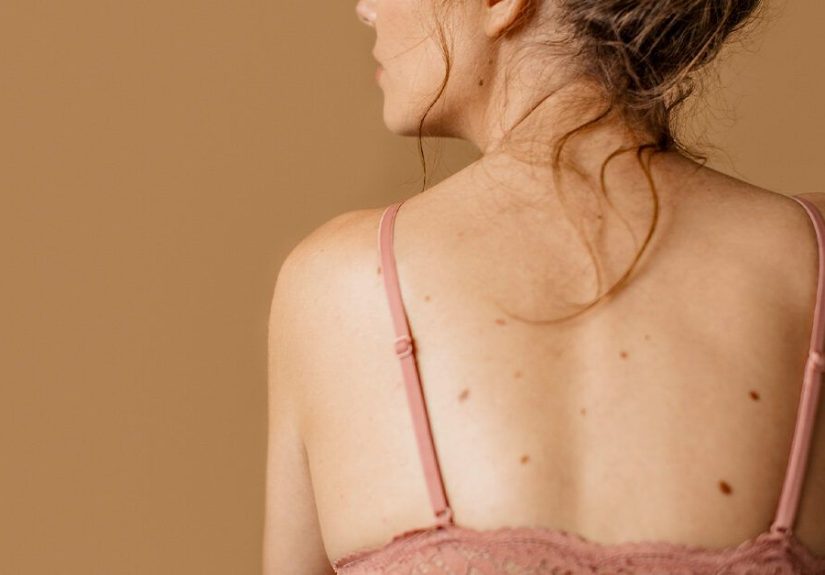 Breast Cancer Moles: Risk Factors, Pictures, Screening Recommendations
