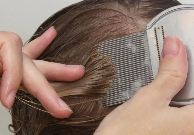 Can Lice Jump? Facts About Head Lice and Nits