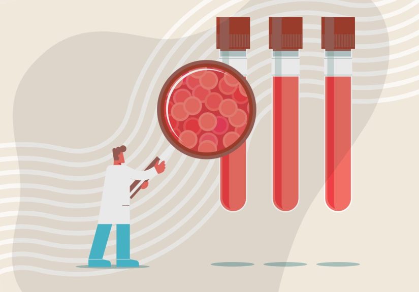 CAR T-Cell Therapy for Multiple Myeloma: What to Expect
