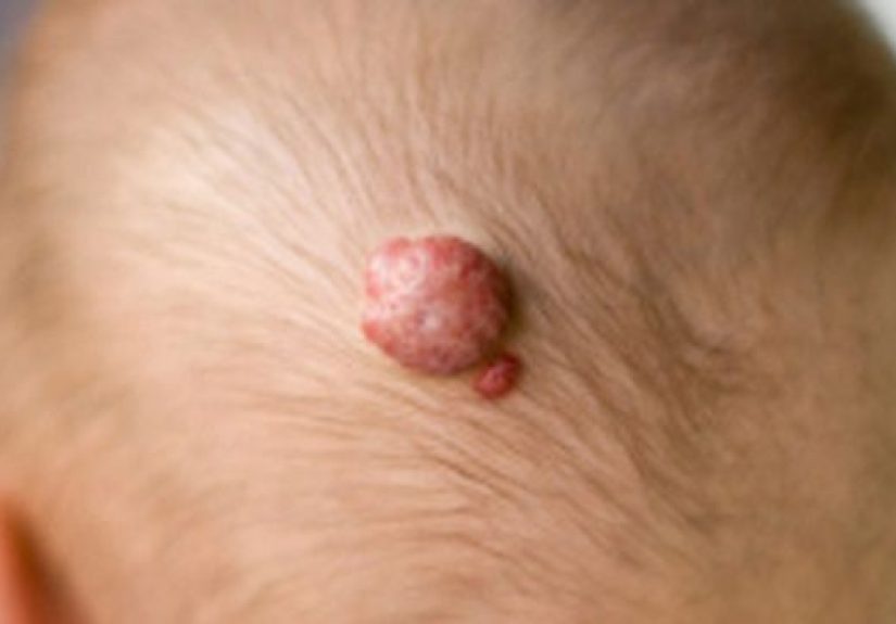 Hemangioma: Symptoms, Diagnosis, and Treatment