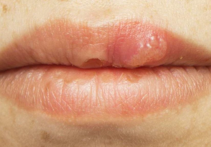Llagas en la boca por VIH: fotos, prevención y tratamiento
