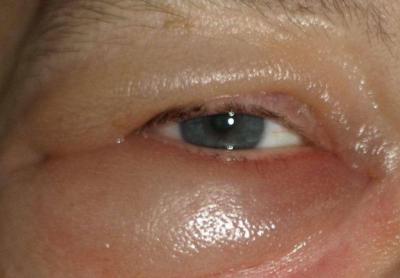 Periorbital Edema: Pictures, Causes, and Treatments
