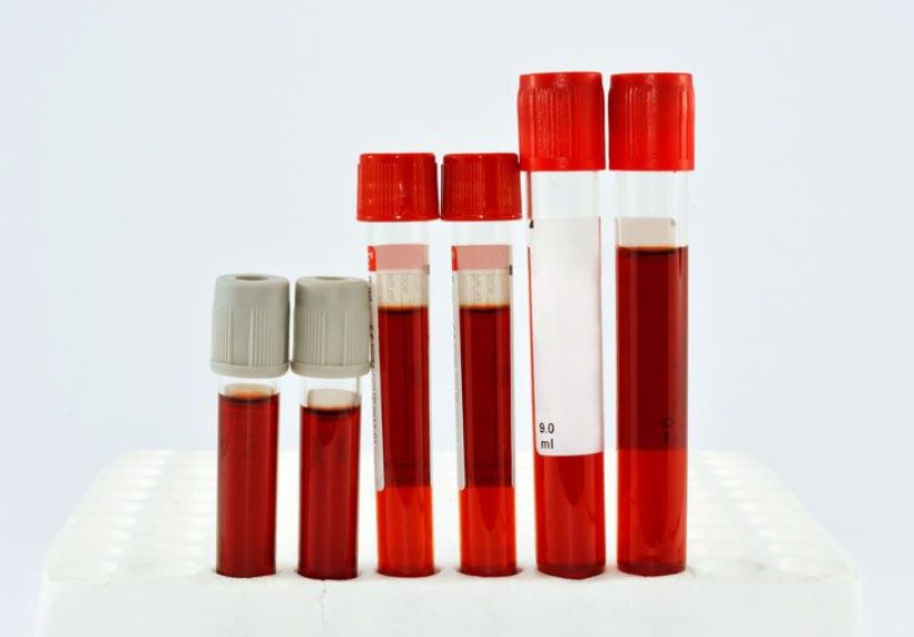 Red Blood Cell (RBC) Count: Purpose and Interpreting Results