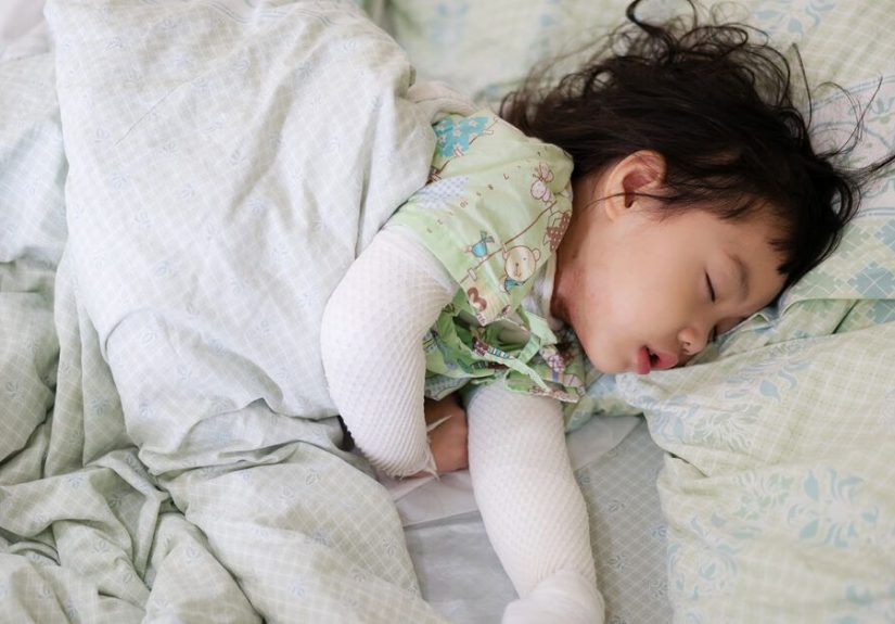 Wet Wrapping to Help Manage Eczema Flare-Ups