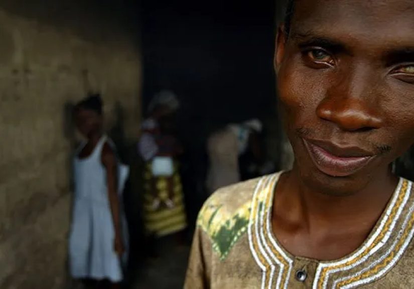 What Is Onchocerciasis (River Blindness)?