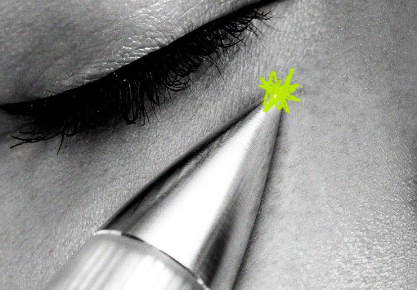 What is plasma fibroblast therapy? Benefits and risks