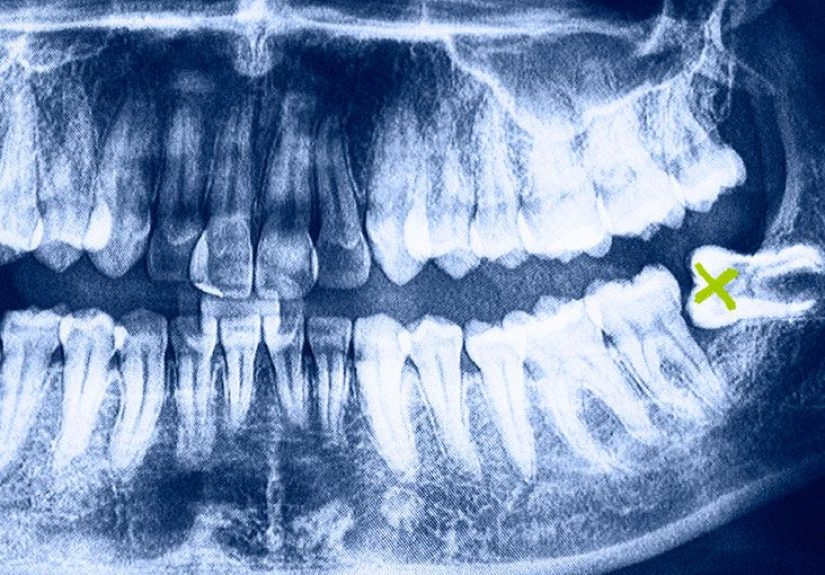 Wisdom teeth removal recovery time: How long and tips for healing