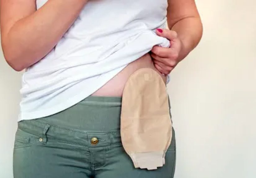 Advanced Gastrointestinal Stromal Tumors (GIST) and Ostomy Care