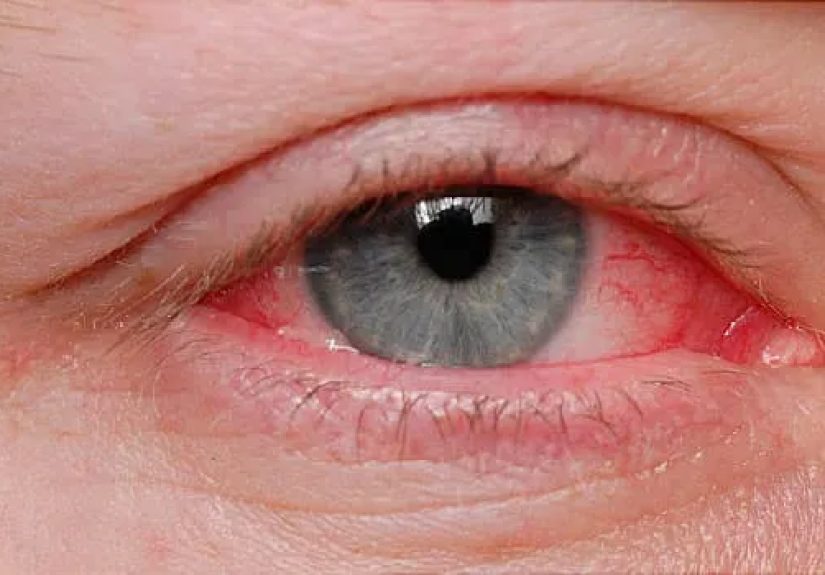 Causes and Treatments For Pinkeye