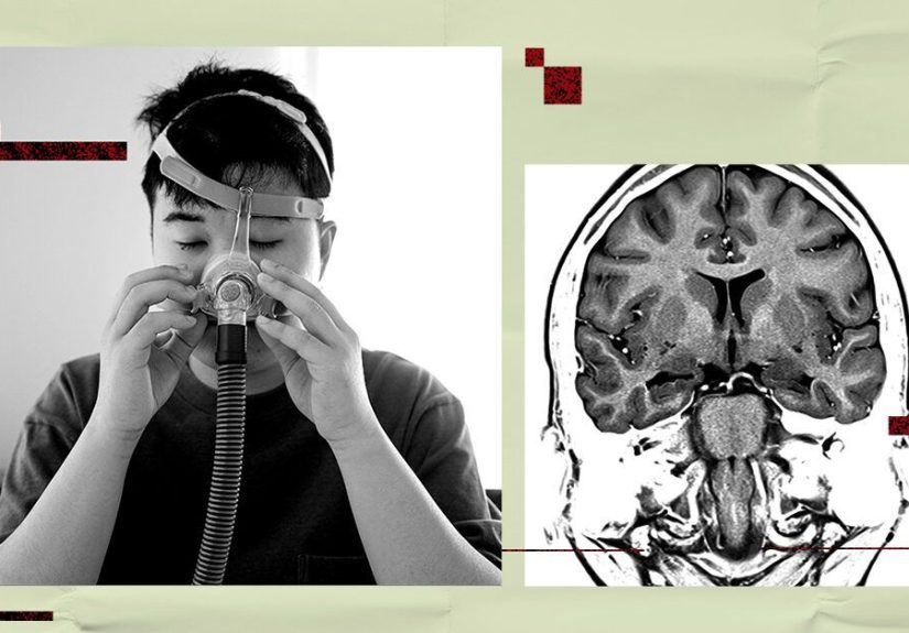 Could treating obstructive sleep apnea lower stroke or dementia risk?