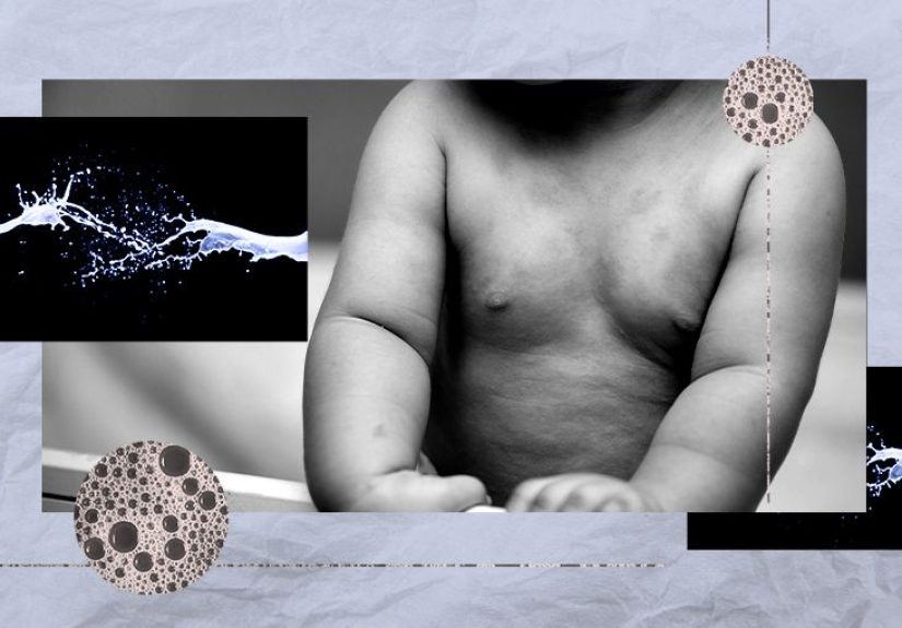 Dairy allergy rash in babies: Pictures, symptoms, and treatment