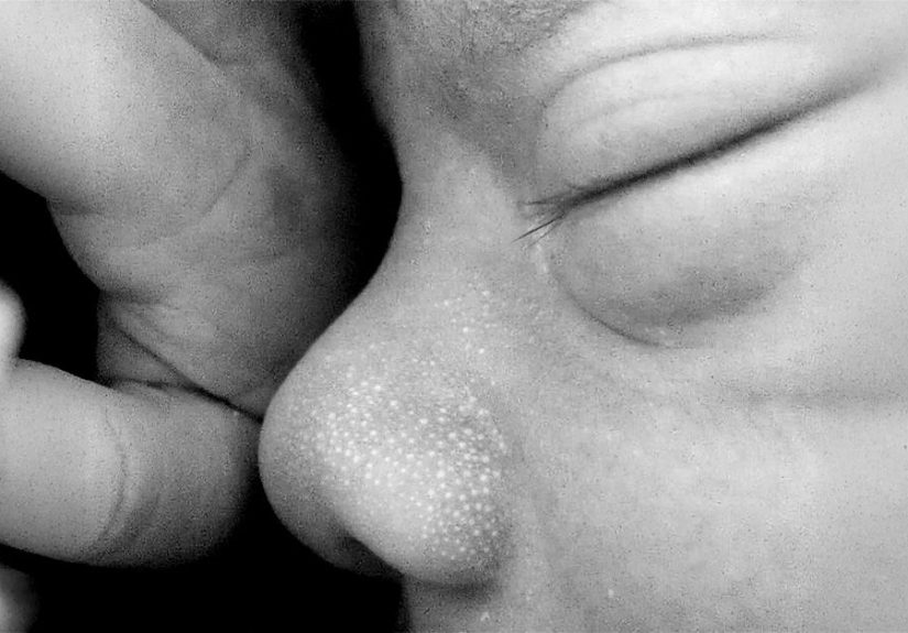 Milia in babies: Symptoms, diagnosis, treatment