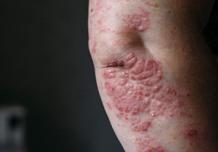 Understanding Your PASI Score For Psoriasis