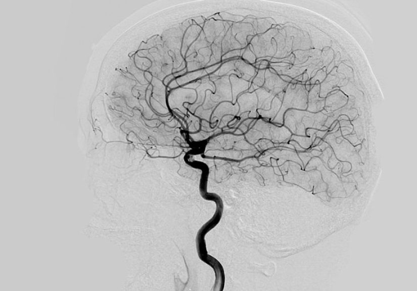 What Is a Cerebral Angiography?