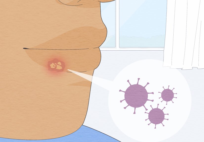 3 Ways to Get Rid of a Cold Sore Fast
