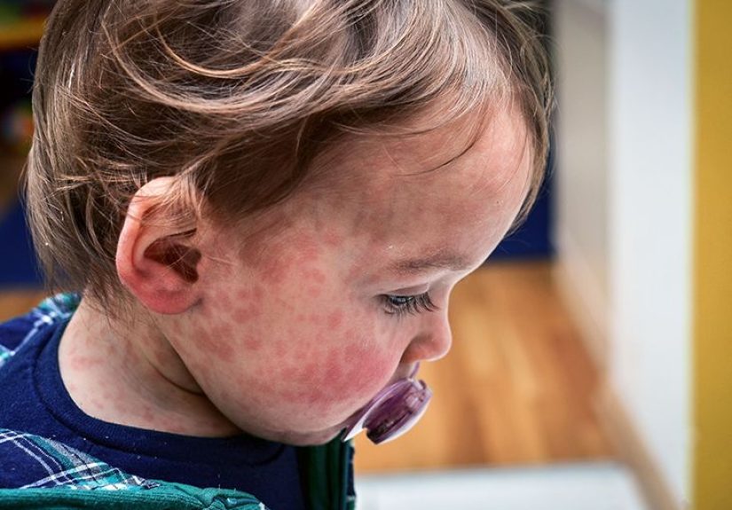 Canada Lost Its Measles-Free Status. U.S. Could Be Next, Experts Say