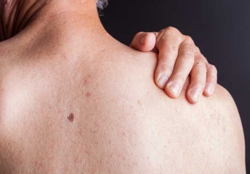 HIV Rash: Pictures, Treatment, and More