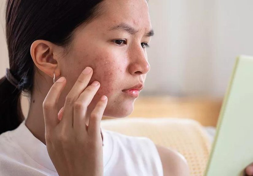 Home Remedies for Acne: Do They Work?