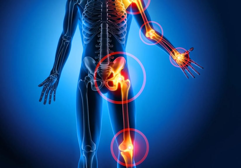 How Psoriasis Affects Your Joints