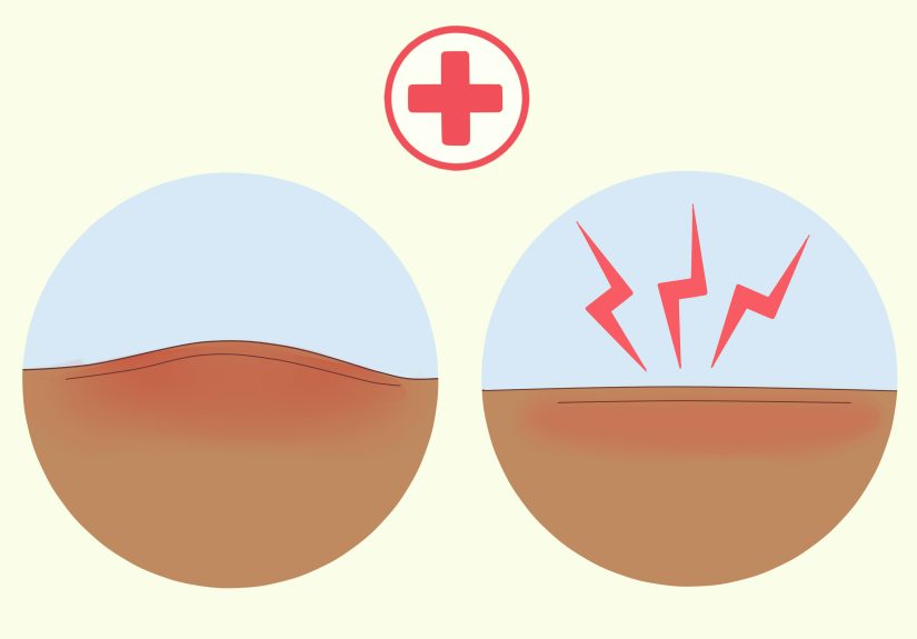 How to Care for a Wound After Stitches Are Removed