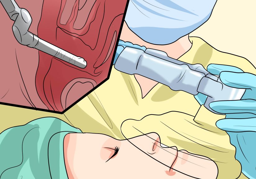 How to Diagnose and Treat a Prolapsed Bladder: Expert Tips