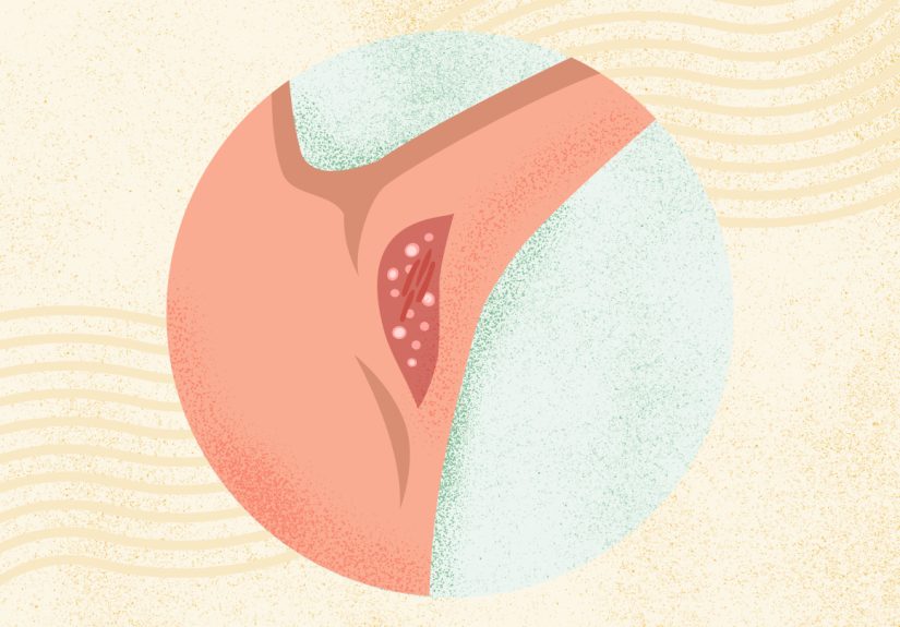 Skin Conditions Resource Center - All Articles