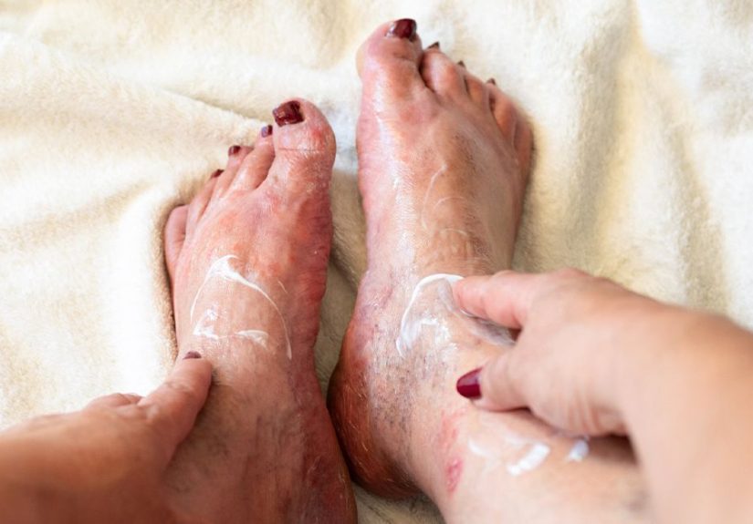 Type 2 Diabetes and Cellulitis: Does One Lead to the Other?