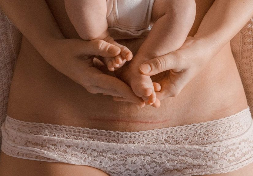 What Do You Do If Your C-Section Incision Is Opening?