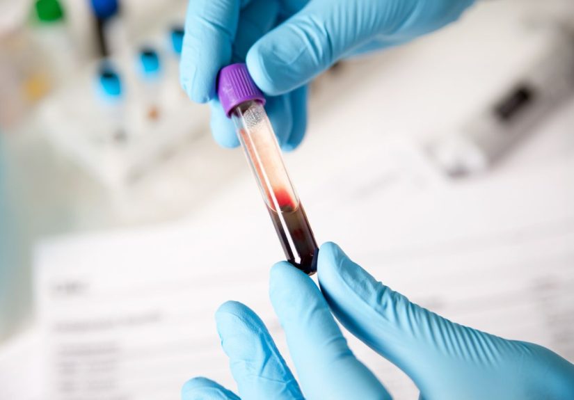 Duchenne Muscular Dystrophy Diagnosis: How to Identify DMD