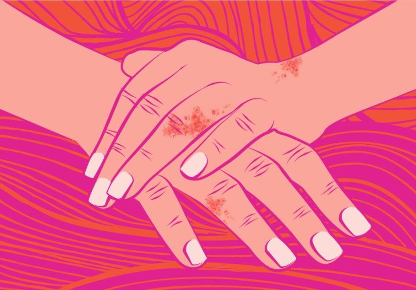 Facts and Statistics About Psoriasis