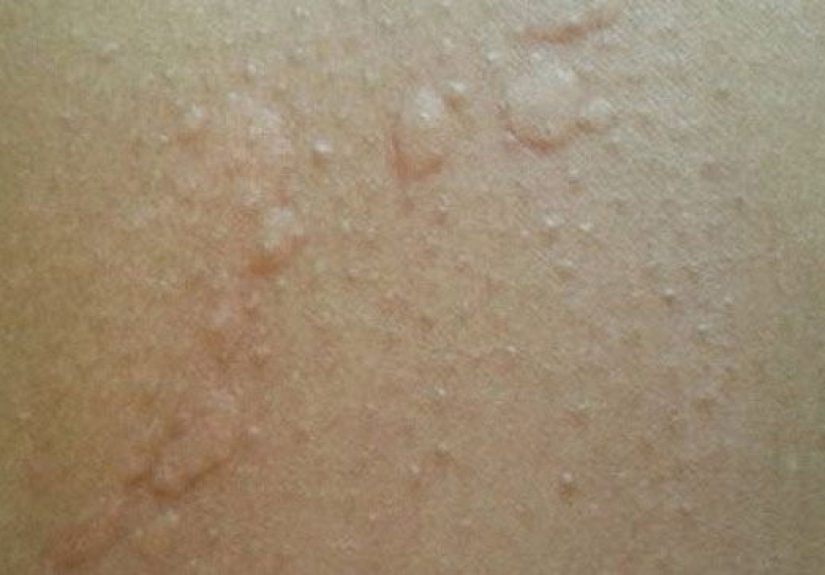 Hives: Causes, Risks, Prevention, and Pictures