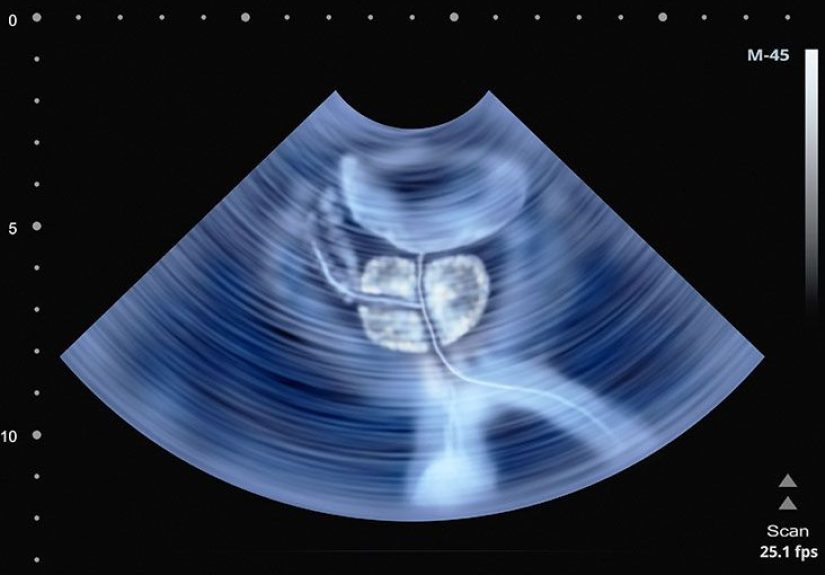 Transrectal Ultrasound: Preparation, Procedure, Cost, and More